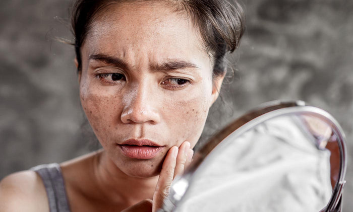 Woman with hyperpigmentation and melasma looking in mirror