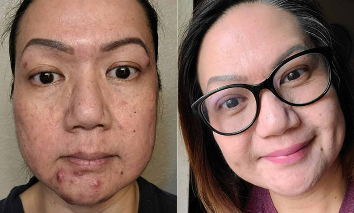 woman before and after acne treatment