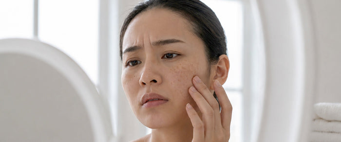 Women with Melasma and Hyperpigmentation looking in the mirror