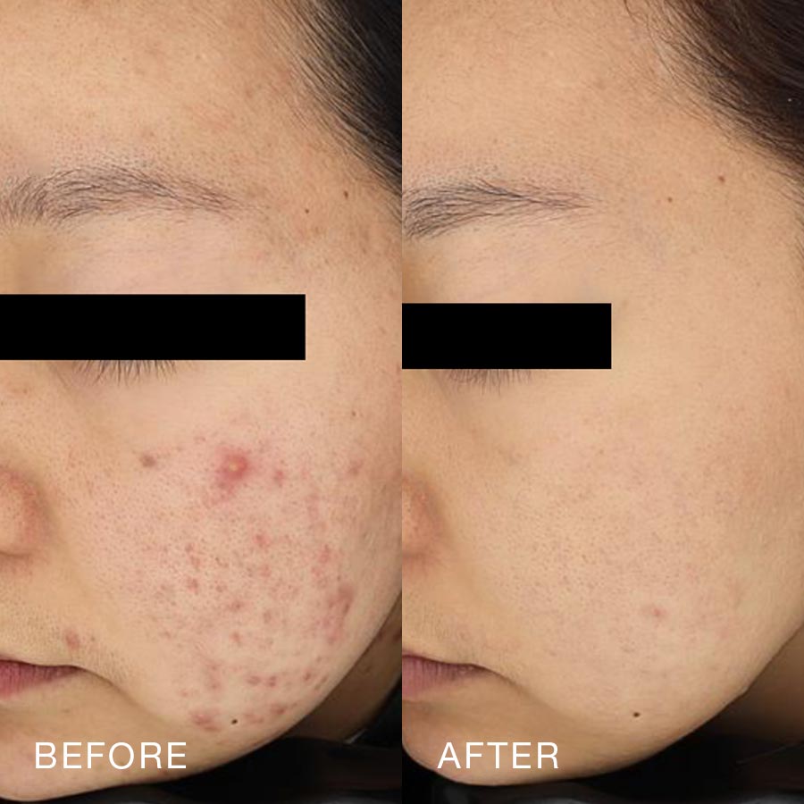 O Skin Med Spa 10 Billion Exosomes Booster Treatment, Before & After