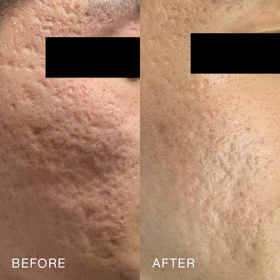 O Skin Med Spa 10 Billion Exosomes Booster Treatment, Before & After