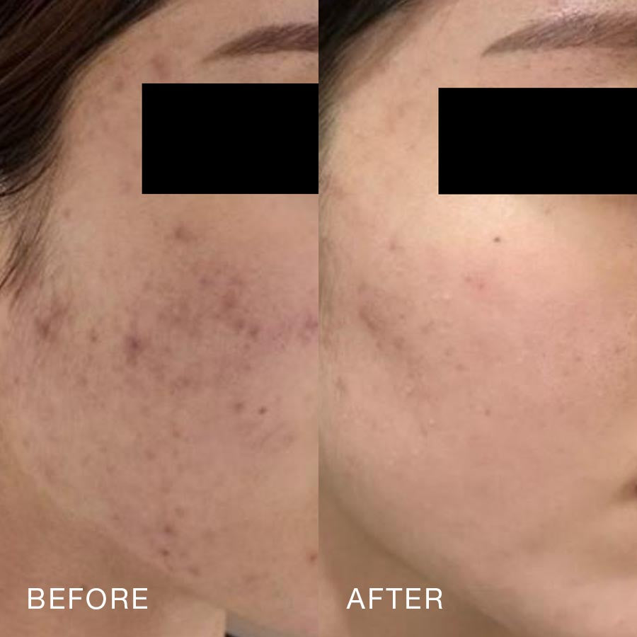 O Skin Med Spa 10 Billion Exosomes Booster Treatment, Before & After