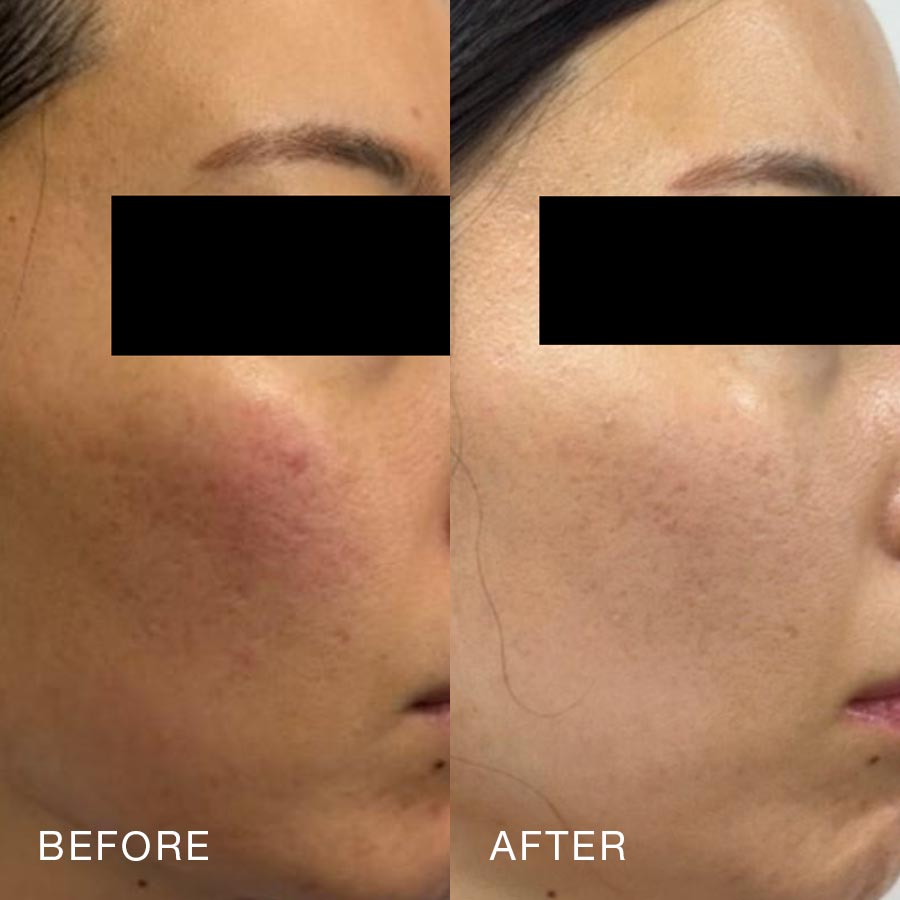 O Skin Med Spa 10 Billion Exosomes Booster Treatment, Before & After
