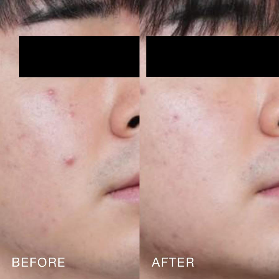 O Skin Med Spa 10 Billion Exosomes Booster Treatment, Before & After