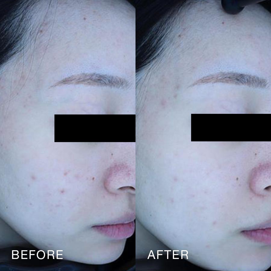 O Skin Med Spa 10 Billion Exosomes Booster Treatment, Before & After
