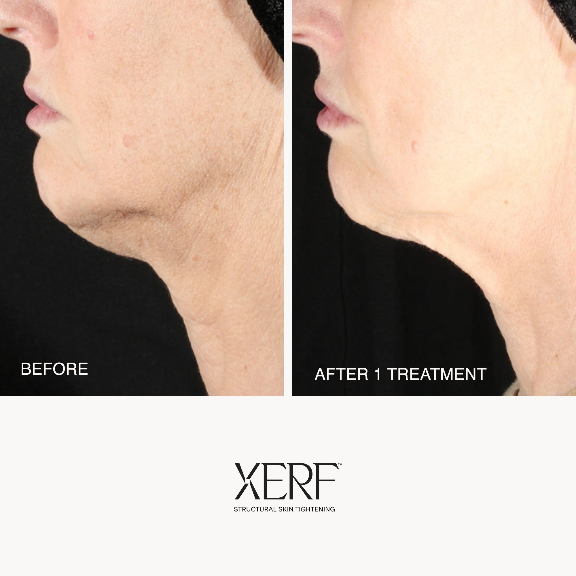 Before and after comparison of a neck treatment with XERF treatment.